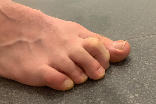 What are Claw Toes?